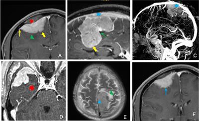 Frontiers The Efficacy Of Preoperative Mri Features In The Diagnosis